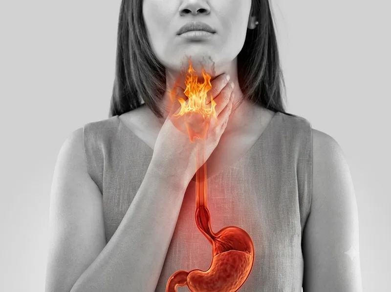 Nóng rát sau xương ức là biểu hiện thường gặp của trào ngược